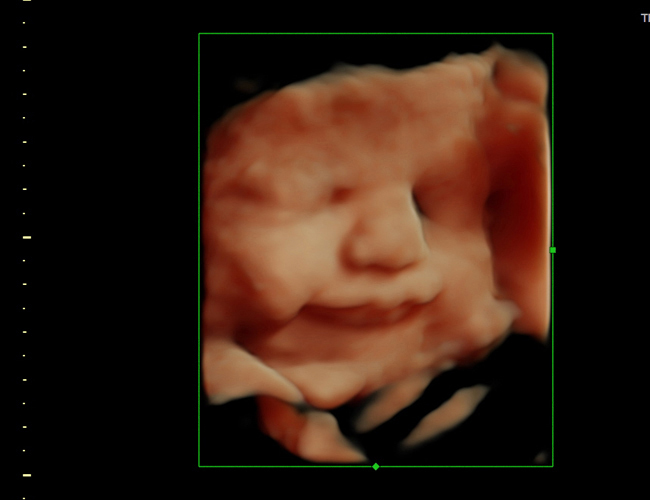 3D ultrasound image at 33 weeks